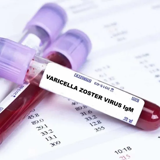 varicella zoster virus (vzv) antibody igm